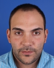 Before Hair Transplant &nbsp;Front